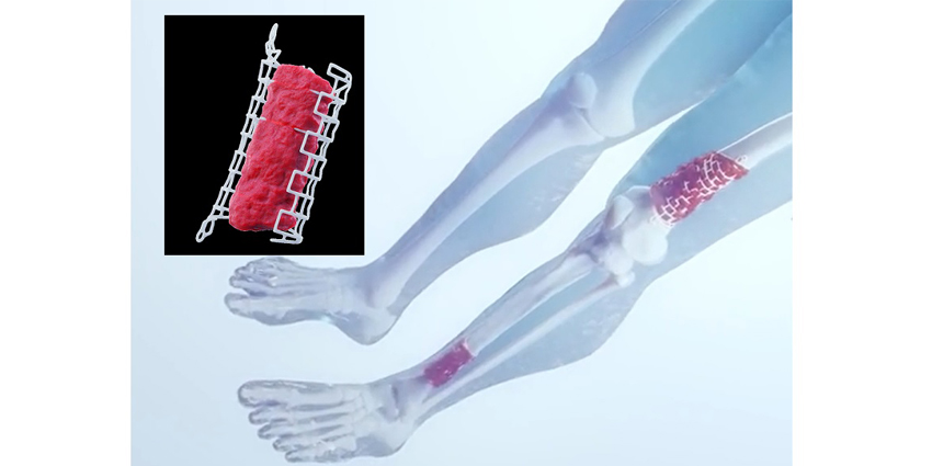 3D Printed Graft Cage: Game Changer?