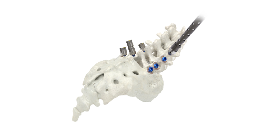 SeaSpine and Implanet Spinal Stabilization System FDA Cleared