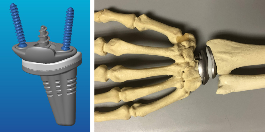 FDA Clears Anika Therapeutics Wrist Replacement System