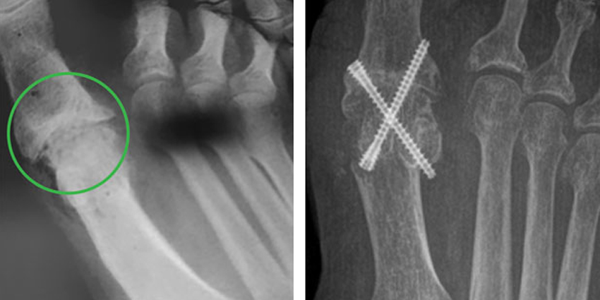 OSSIOfiber Bio-Integrative Compression Screws Cleared