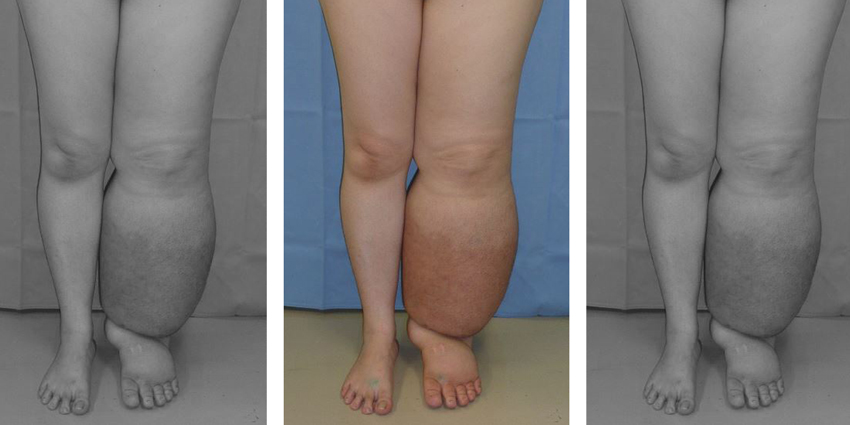 Independent TKA Failure Factor Uncovered in Mayo Study