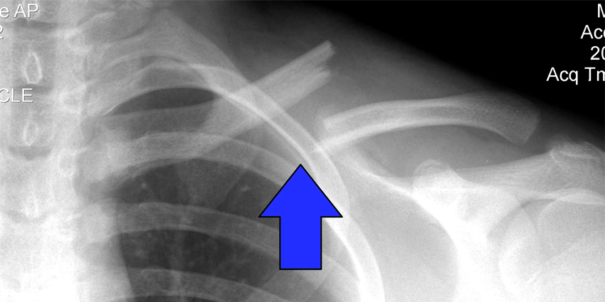 Subscapular Cortisone Injection Can Improve Scapuloplasty Outcomes