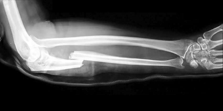 Pediatric Monteggia Fracture Dislocation Treatment Study