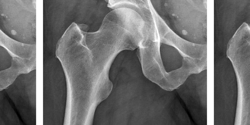Hip Joint Space Width: Type of Radiograph Irrelevant?