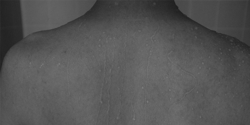 How Impactful are Subscapularis Tendon Tears?
