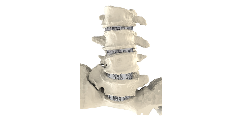 Carlsmed: FDA Breakthrough Designation, Cash and Talent