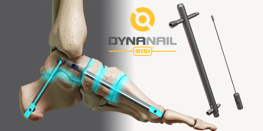 DynaNail Now Available for Medial Column Fusion