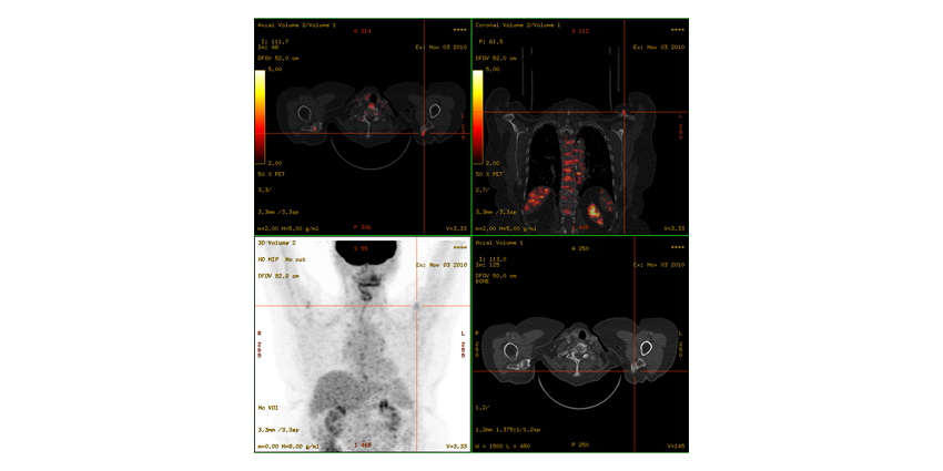 Affect of Diabetes, Heart Disease on Knee OA Less Than Expected