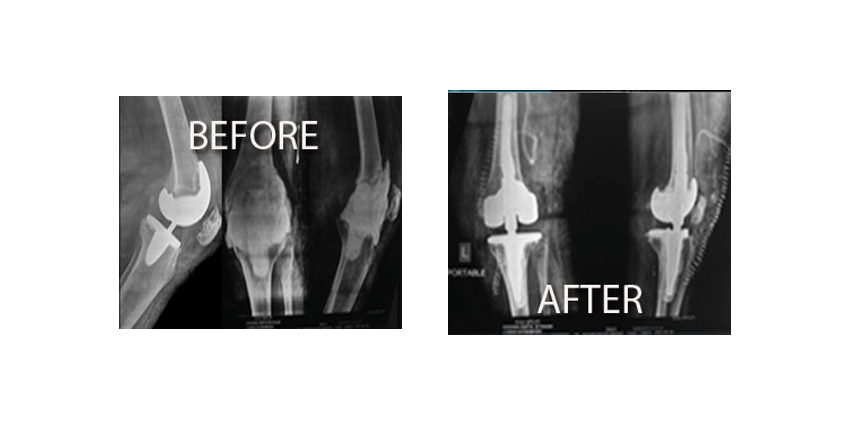More Evidence FOR TJA in the ASC Setting