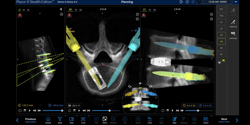 Medtronic’s Evolving 3-D Mazor Platform Gets New FDA Clearance
