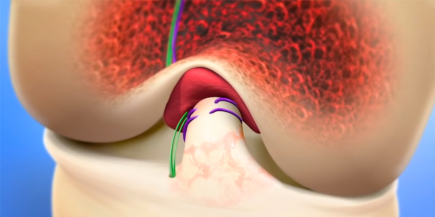 FDA Announces De Novo Authorization for New ACL Rupture Treatment