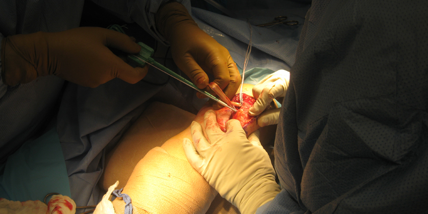 Implant Extractions After TKA Infection: New Insights