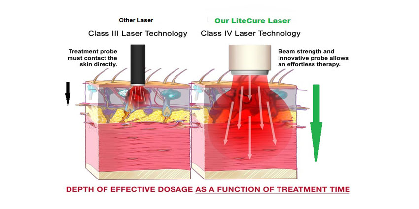 DJO Acquires LiteCure Laser Therapy