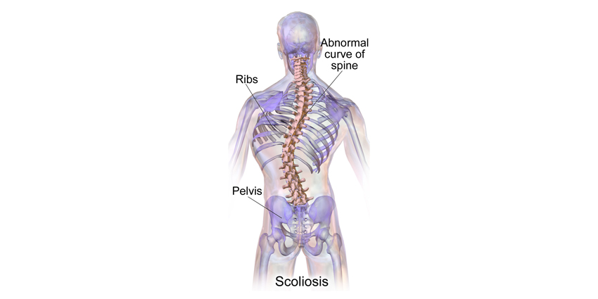 How Critical Is Axial Plane Effect to AIS Bracing Success?