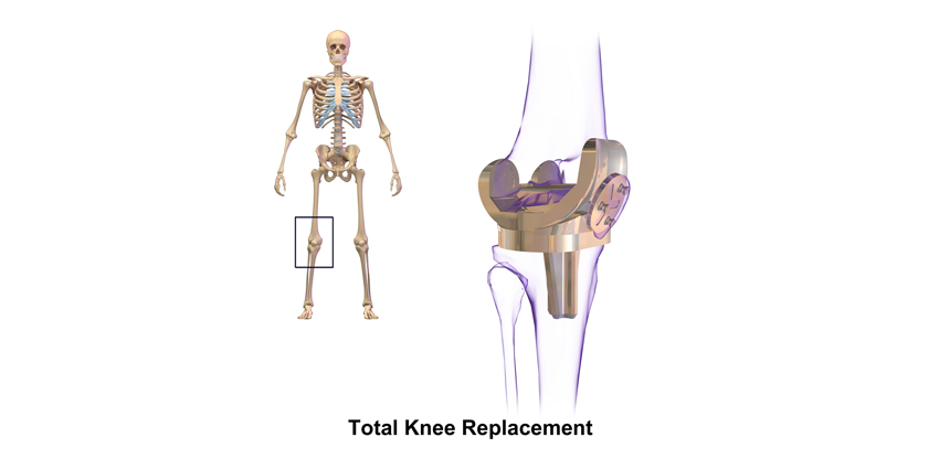 Implant Design Alone Not Enough, Says New Study