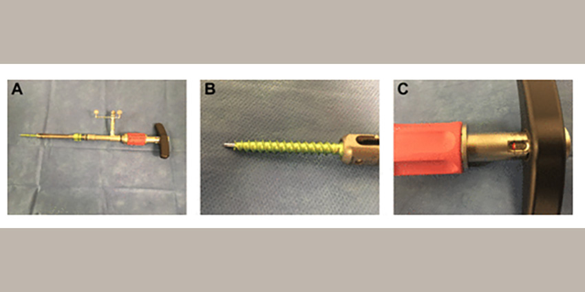 New 1-Step Pedicle Screw System Tested