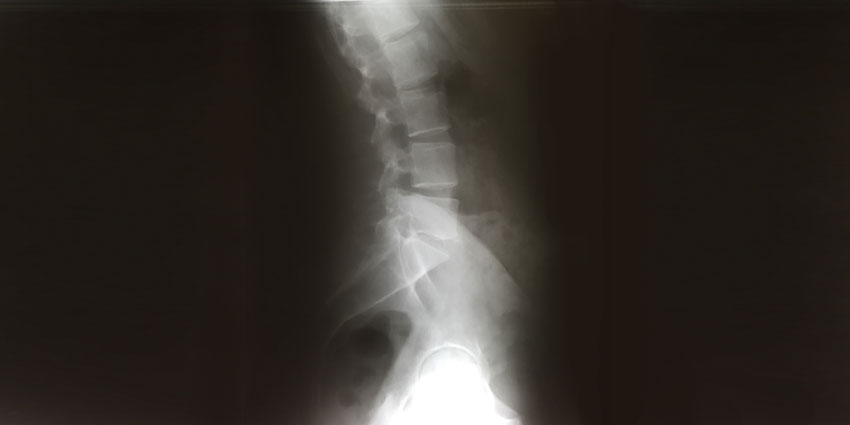 Do Bisphosphonates Affect Fusion Rates in Osteoporotic Patients?