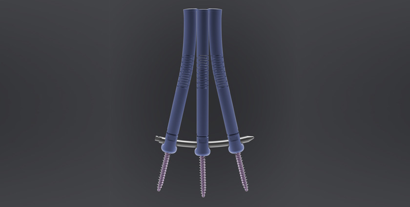 First-in-Man for Minimally Invasive Flex Tower