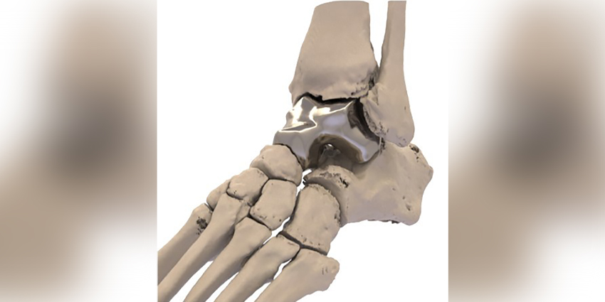 Humanitarian Approval for “First-Of-Its-Kind” Bone Replacement