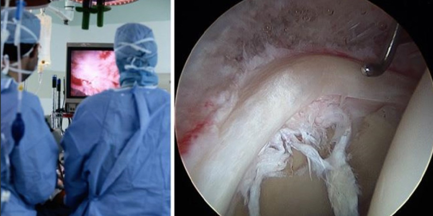 Study Tracks Hip Endoscopy Complication Rates
