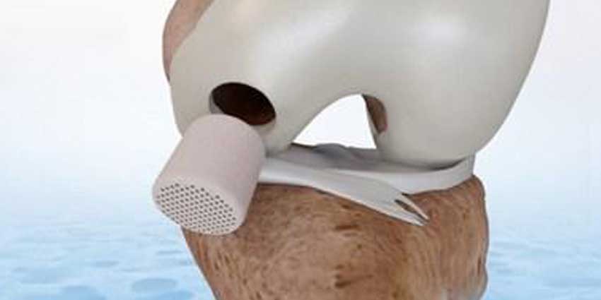 Landmark Cartilage Repair Study: Agili-C Superior Over Std of Care