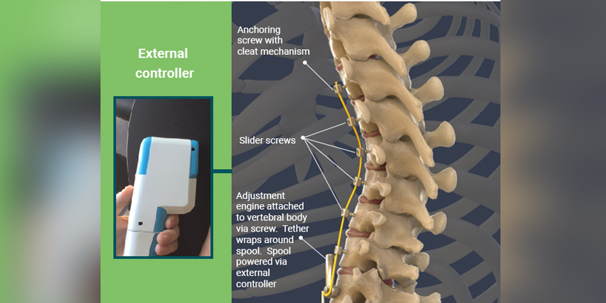 New Patent/Breakthrough Status for Auctus’ Vertebral Tethering