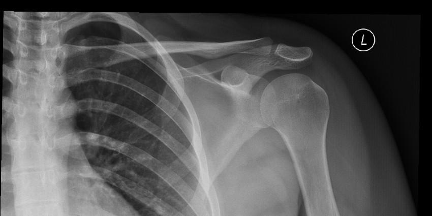 What’s the Connection Between Age and Shoulder Stabilization?