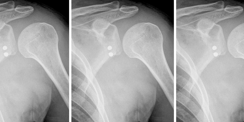 Cortical Buttons vs. Screws for Latarjet