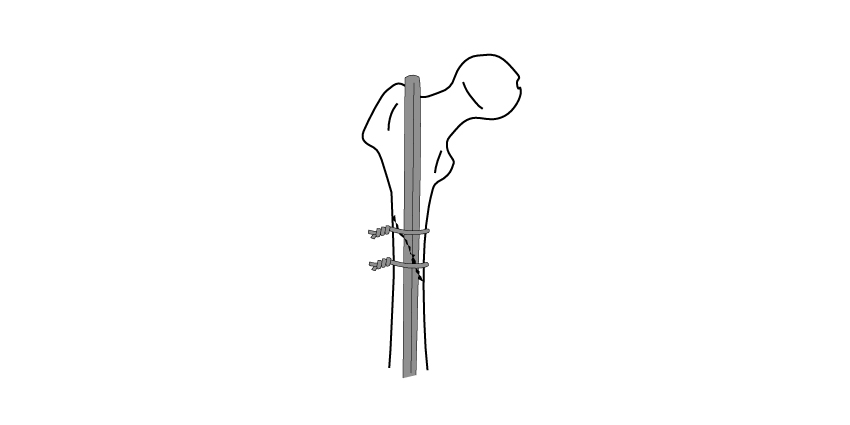 Do Cerclage Wires Affect Infection Rates?