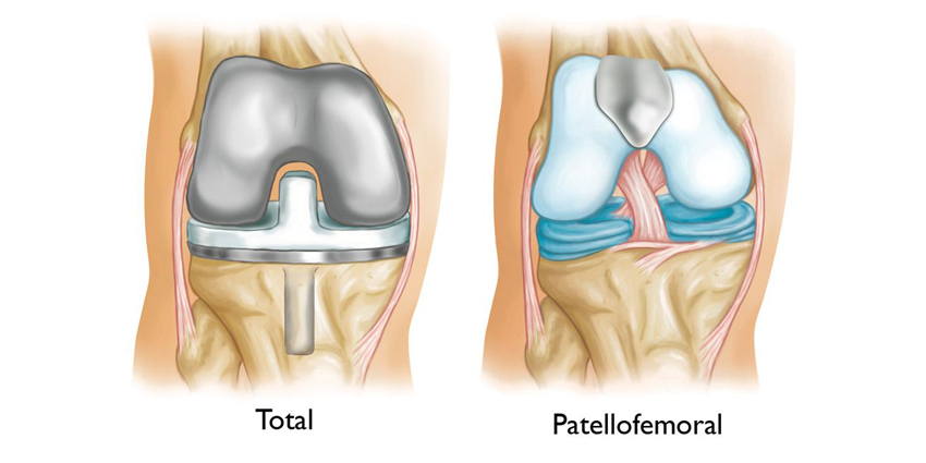 6-Year Patellofemoral Arthroplasty Follow-Up Data