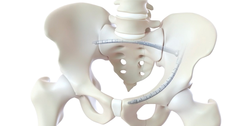 Novel Curved IM Implant Used in 100th Pelvic Fracture Patient