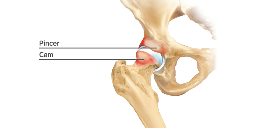 Progression of Femoroacetabular Impingement in Contralateral Hip