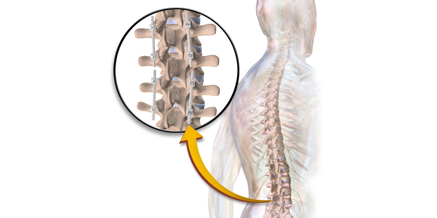 Tethering vs Fusion for Adolescent Scoliosis: New Study