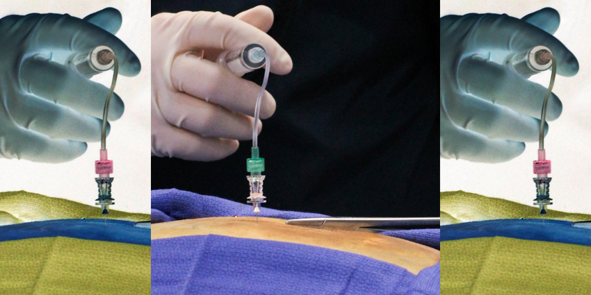 Continuous Peripheral Block=Less Manipulation Under Anesthesia?