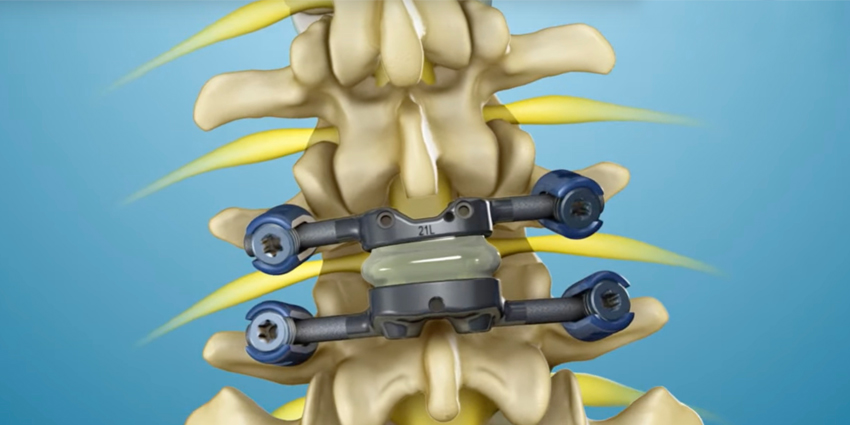 New Study Examines Facet Replacement for Spondy, Stenosis