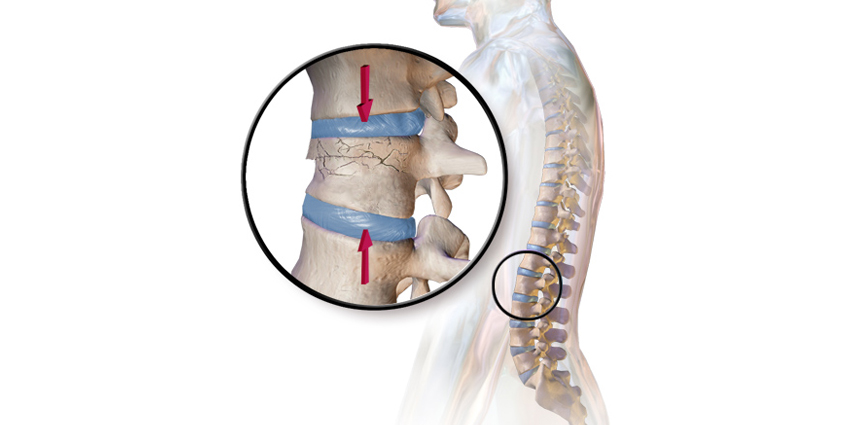 Osteoporotic Vertebral Fractures: 2 Weeks’ Hospitalized Bed Rest?!