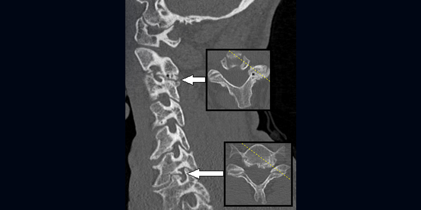 Is a Block Safer Than Epidural Steroid Injections?