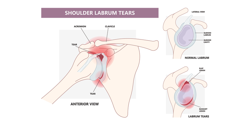 Is Bone Loss a Primary Factor in Bankart Failure?