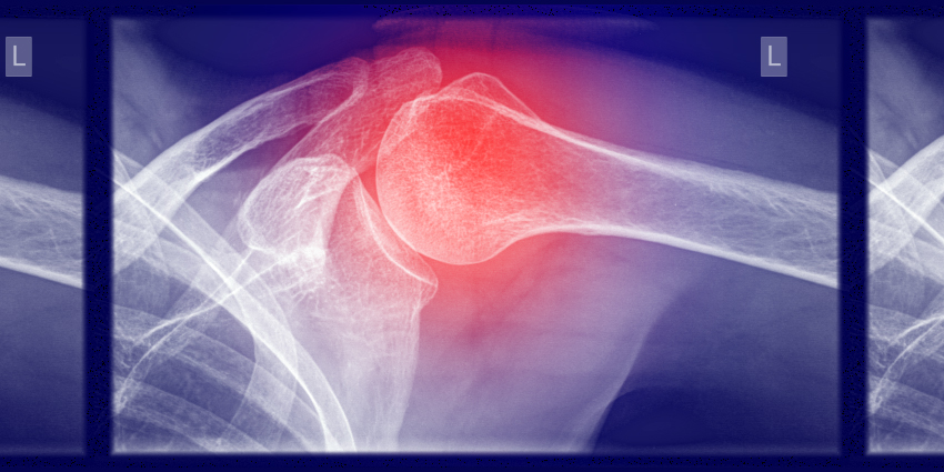 PACS Shoulder Surgery Shines in New Study