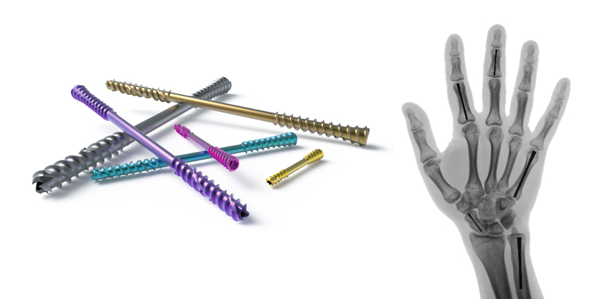 Medartis and Field Orthopaedics Partner to Expand Offerings