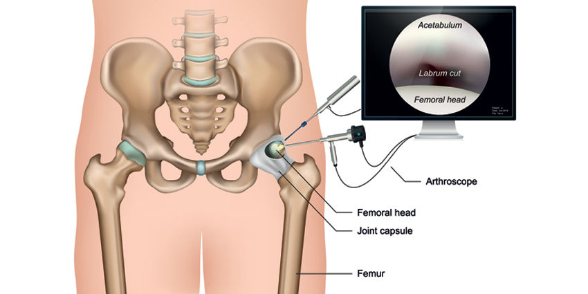Is Faster Better for Staged Hip Arthroscopies?