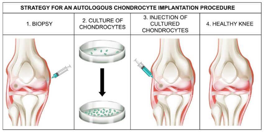 Cartilage Repair Rising, Reop Rates Falling: New UCSF Study