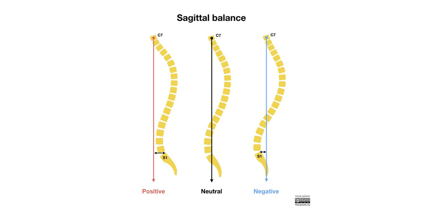 Sagittal Balance Plays Limited Role in Adjacent Segment Disease
