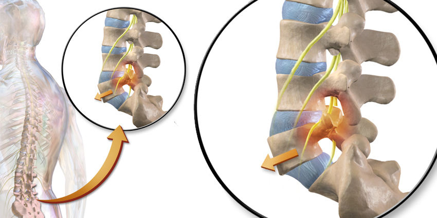 Fusion or Decompression for Spondylolisthesis?