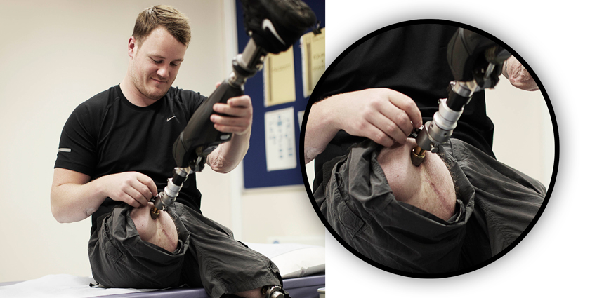 Osseointegrative Prosthetics: Live Longer or Shorter?