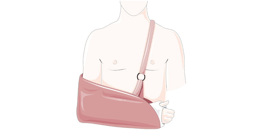 How to Predict Which Patients Will Wear Their Slings