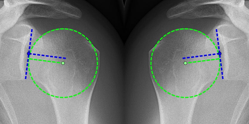 The Value of the Arthroscopic Trillat Procedure