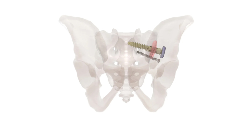 FDA Clears New SI Joint Fusion System