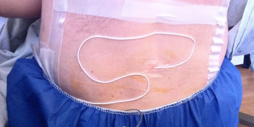 Wound Drains Increase Hospital LOS After Lumbar Surgery?