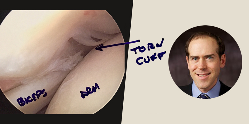No Benefit to Intraoperative Channeling in Rotator Cuff Repair?